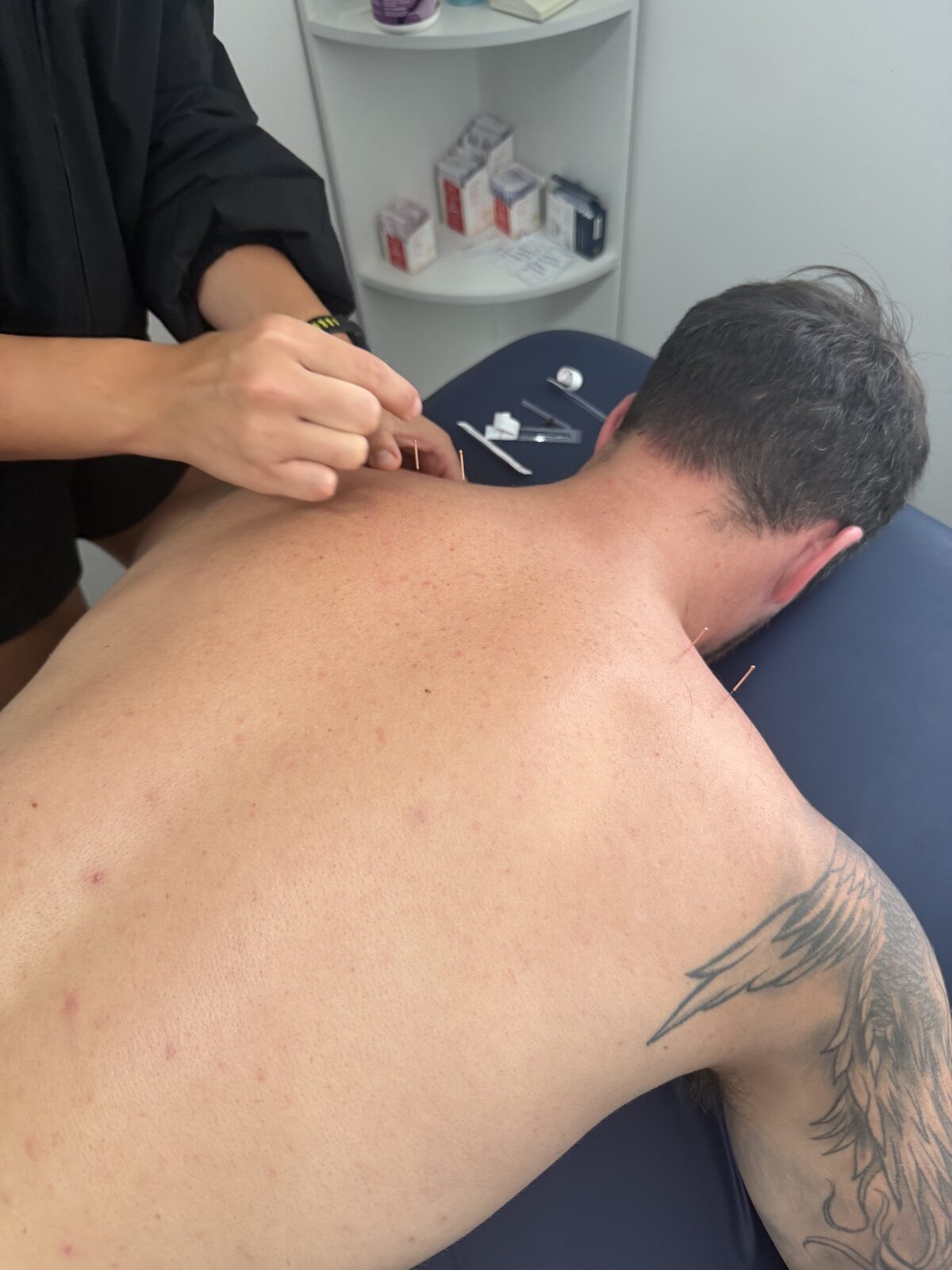 Dry needling to the neck and shoulder muscles